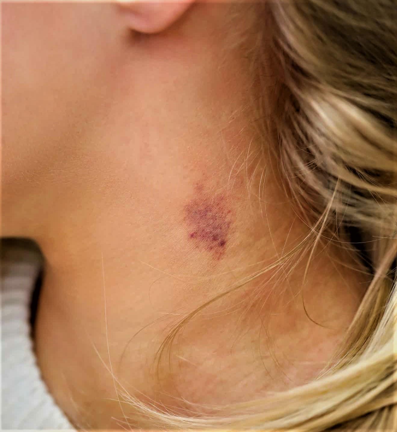 How To Give Yourself A Hickey On Your Neck? Fake Love Bites » Making