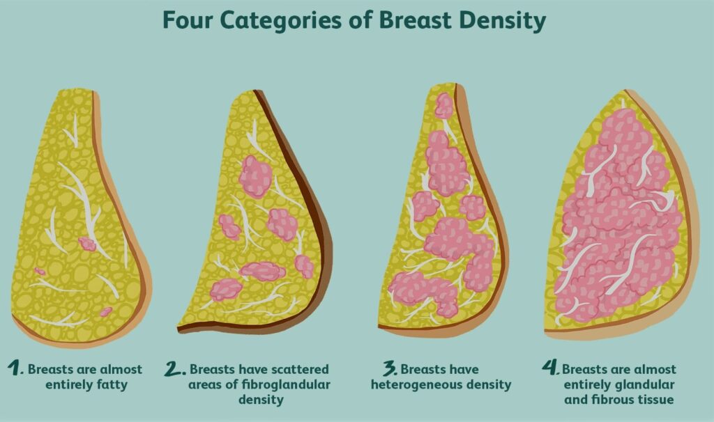 High Breast Density