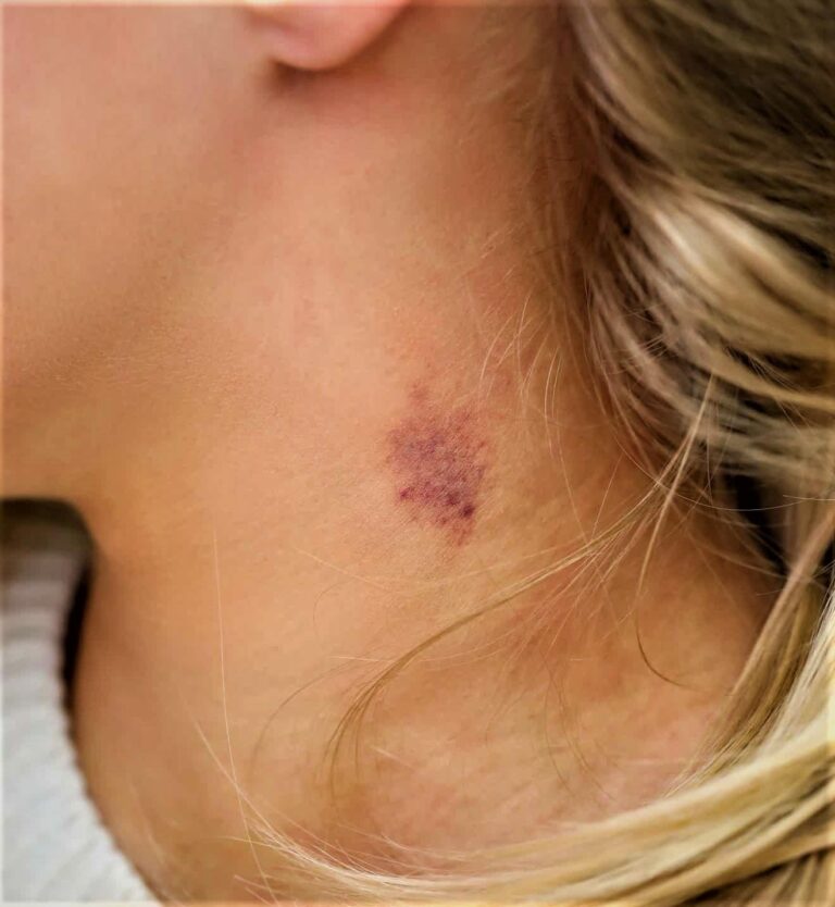 top-10-easy-ways-to-get-rid-of-a-hickey-overnight-hickeys-how-to