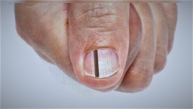 black-lines-on-nails