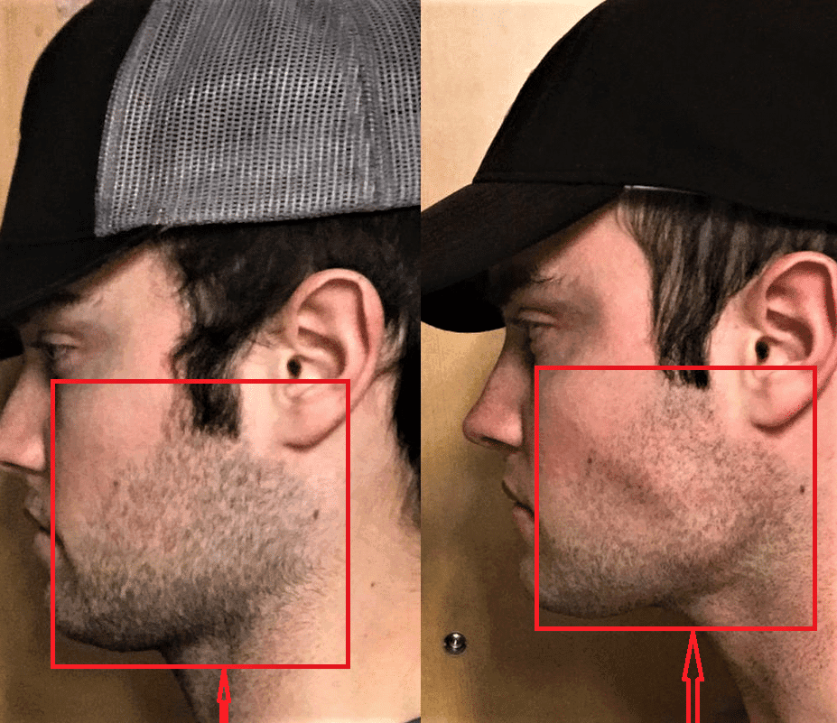 Best Jaw Exercises Do Jawline Exercises Actually Work 