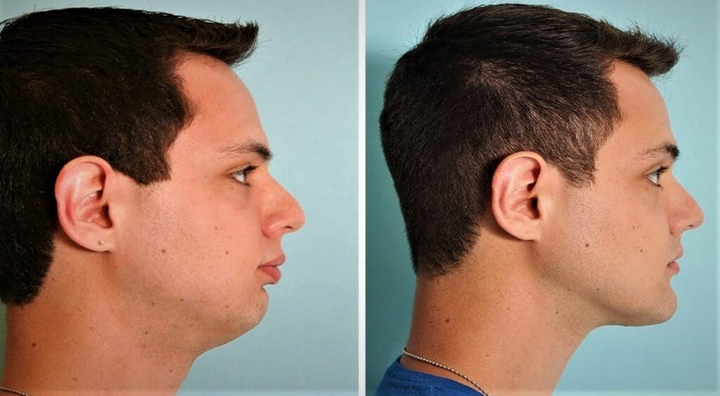 Chiseled Jawline Exercise