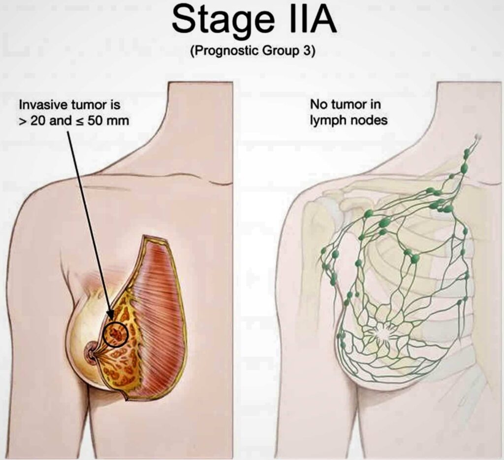 Stage 2 Breast Cancer